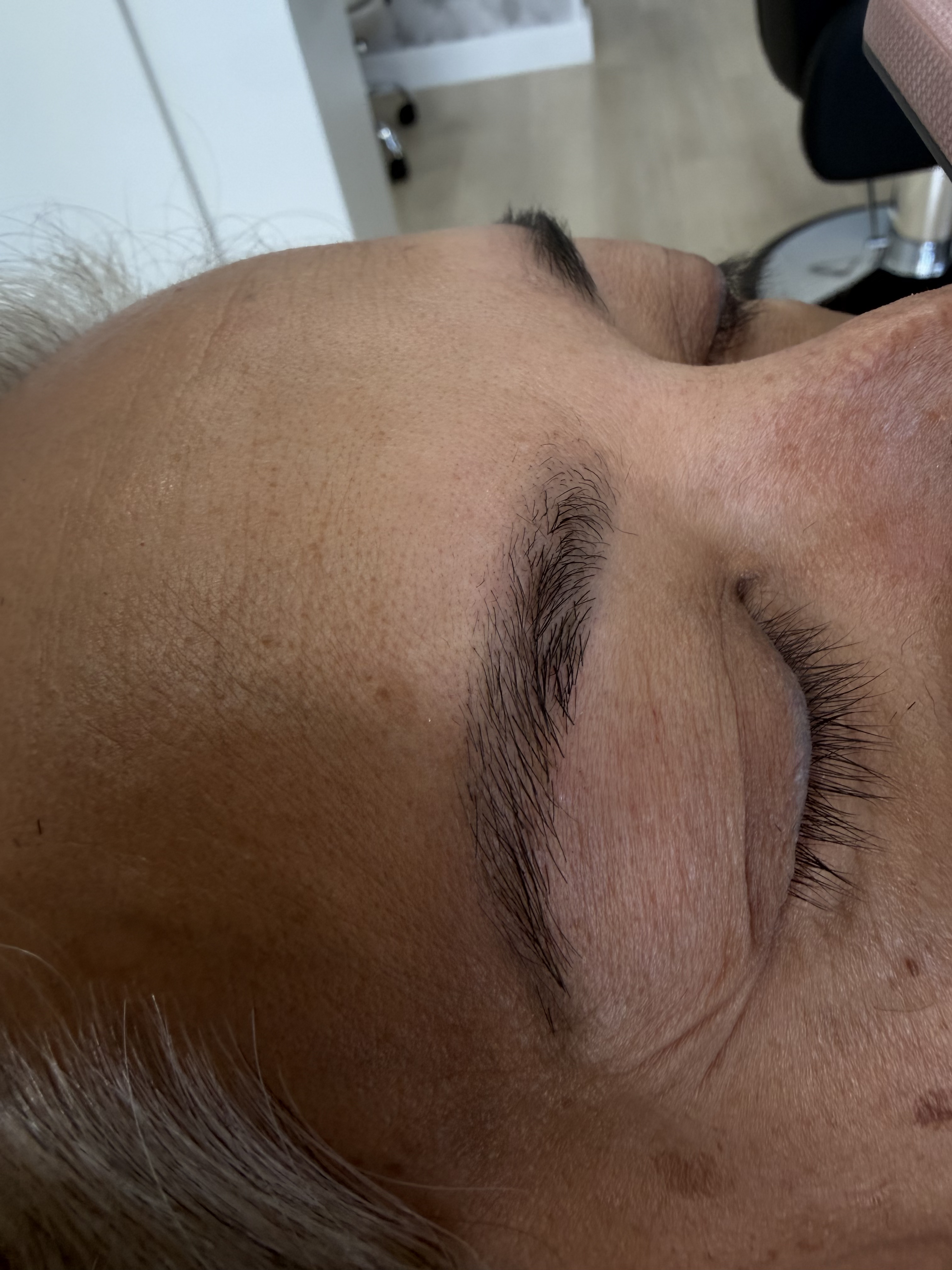 Brow Lift